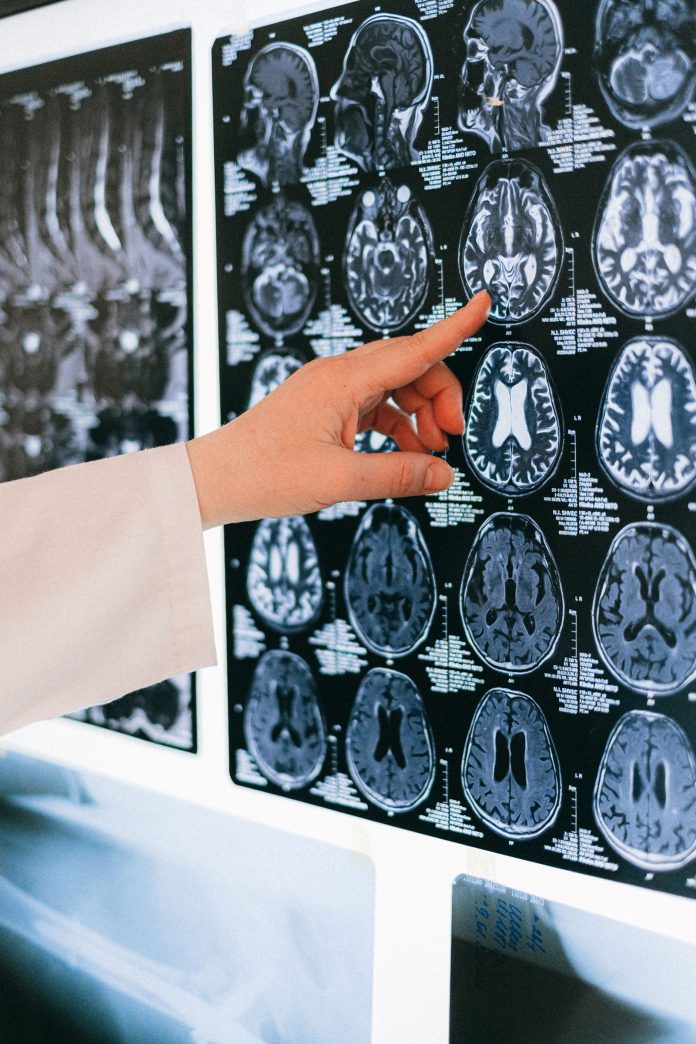 Doctor pointing to brain MRI scan on lightbox